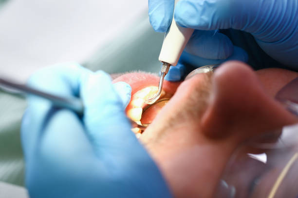 Best Dental Abscess Treatment in Jacksboro, TX